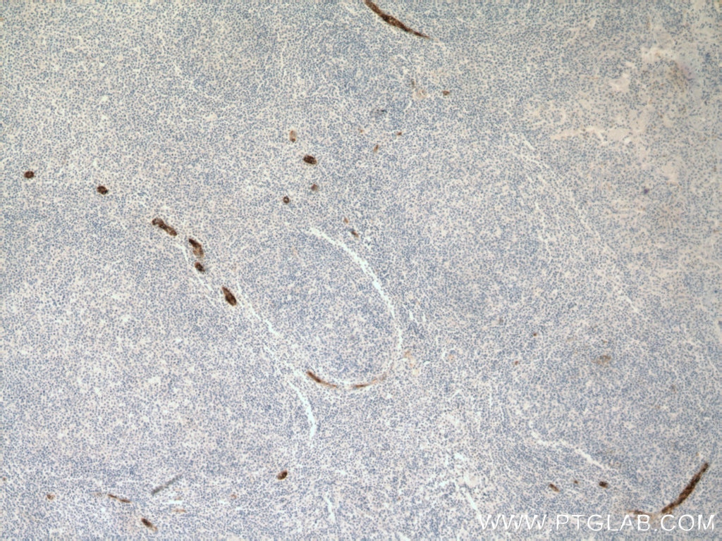 IHC staining of human tonsillitis using 66594-1-Ig