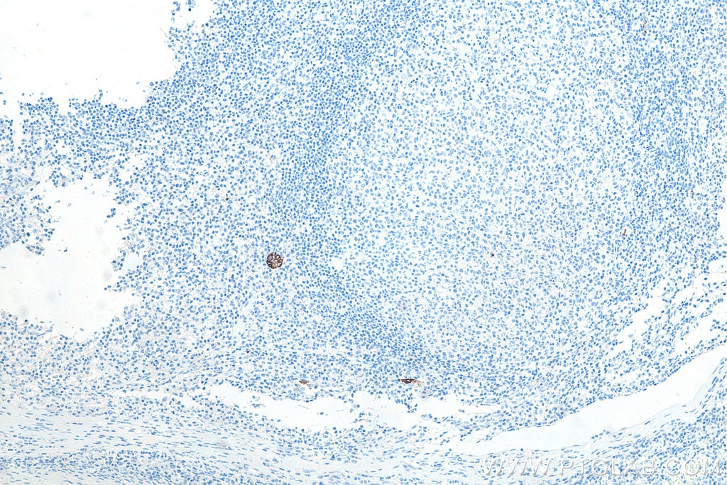 Immunohistochemistry (IHC) staining of human tonsillitis tissue using MAdCAM1 Monoclonal antibody (66594-1-Ig)