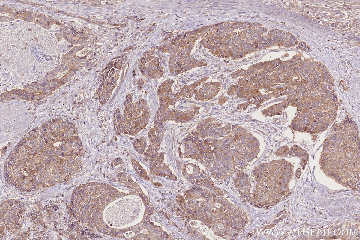 Immunohistochemistry (IHC) staining of human stomach cancer tissue using MADD Polyclonal antibody (29663-1-AP)