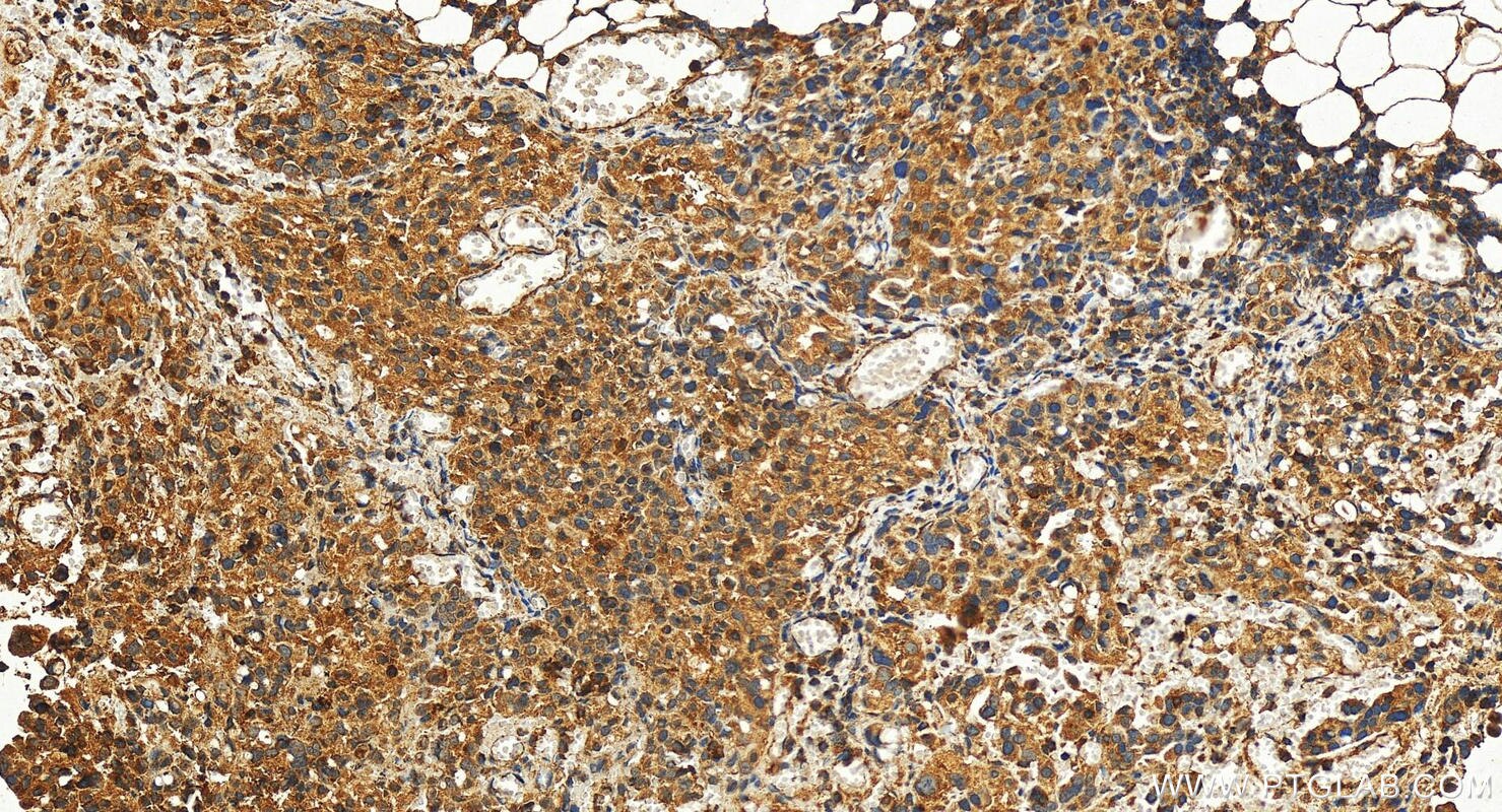 Immunohistochemistry (IHC) staining of human ovary cancer tissue using MADD Polyclonal antibody (29663-1-AP)