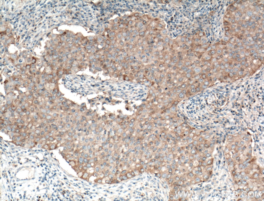 Immunohistochemistry (IHC) staining of human breast cancer tissue using MAEA Polyclonal antibody (15238-1-AP)