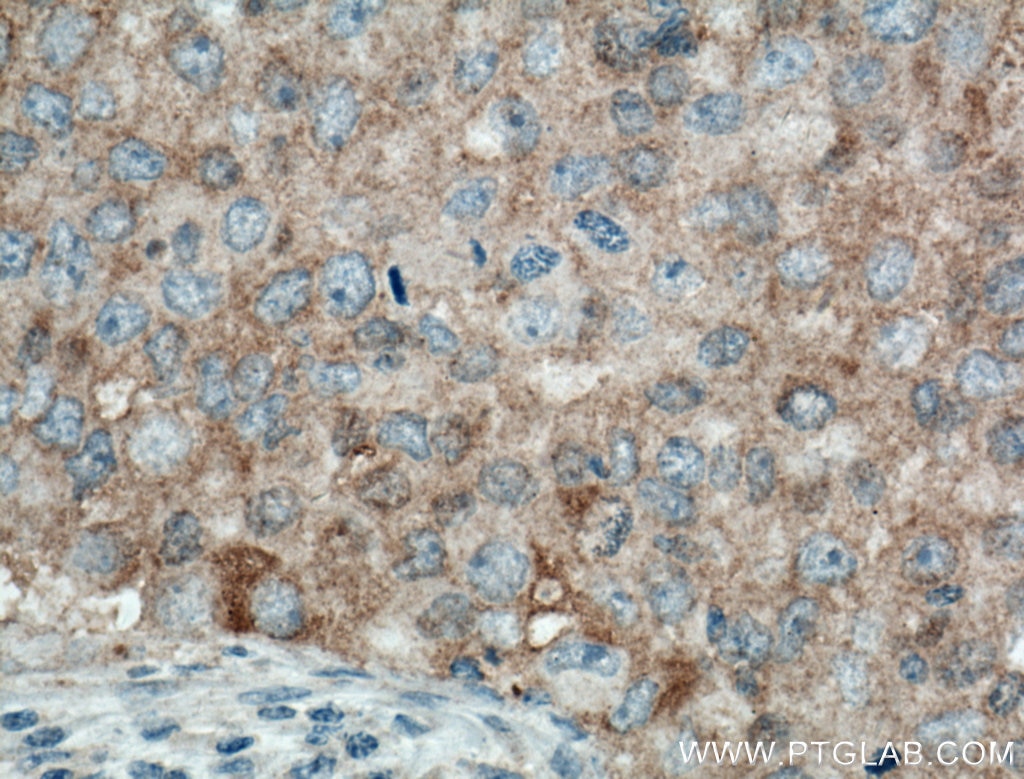 Immunohistochemistry (IHC) staining of human breast cancer tissue using MAEA Polyclonal antibody (15238-1-AP)