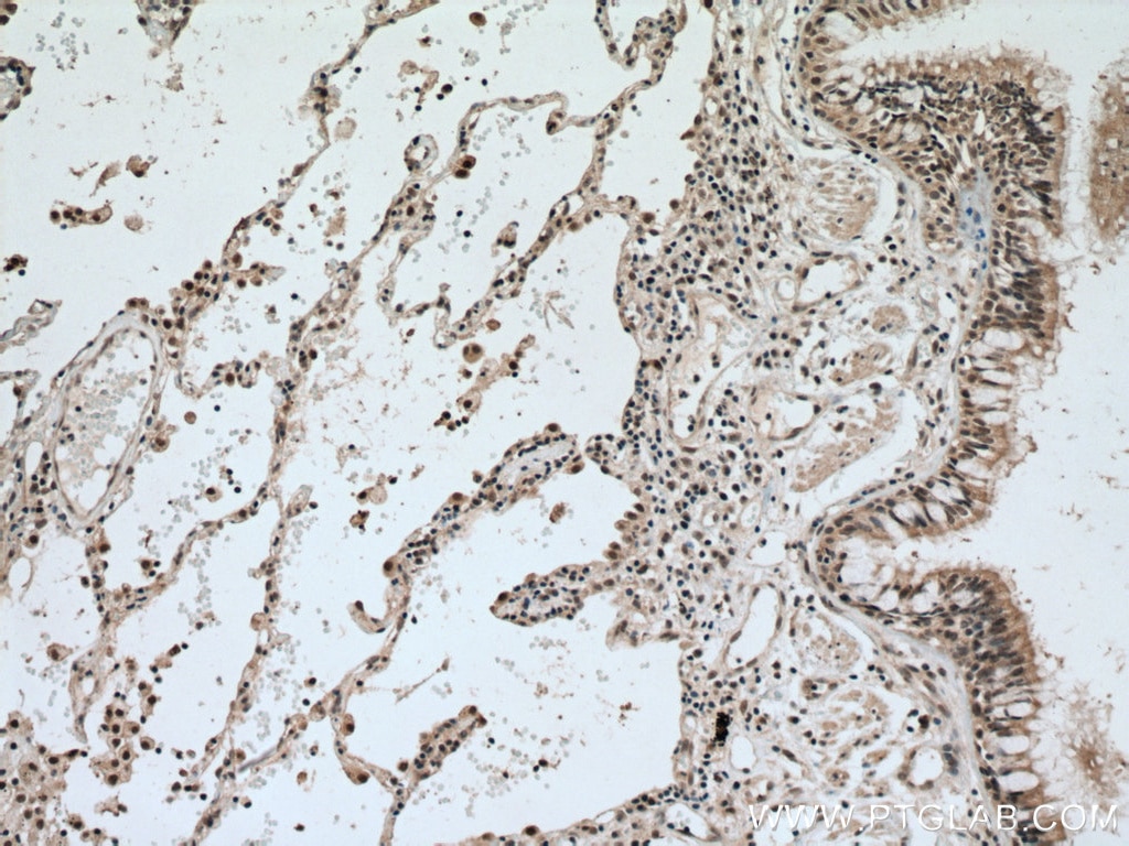 Immunohistochemistry (IHC) staining of human lung cancer tissue using MAEA Polyclonal antibody (15238-1-AP)