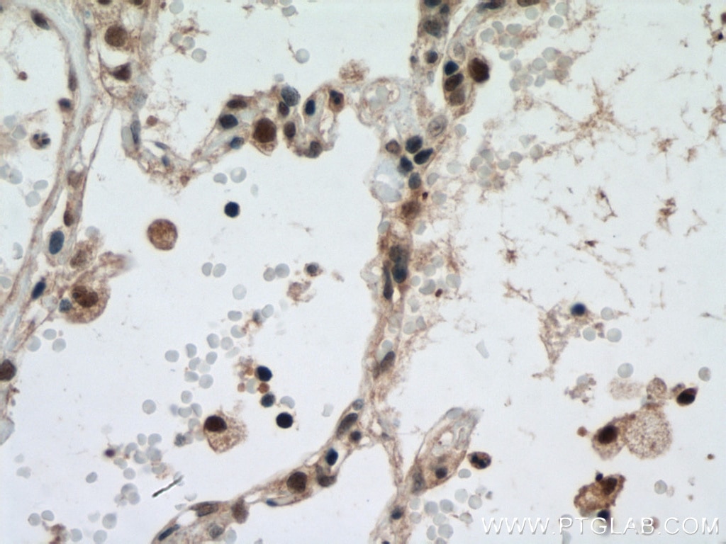 IHC staining of human lung cancer using 15238-1-AP