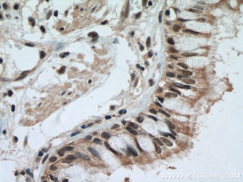 IHC staining of human lung cancer using 15238-1-AP