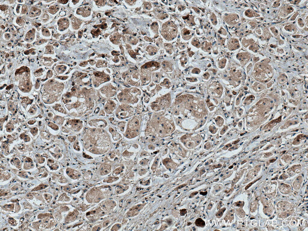 Immunohistochemistry (IHC) staining of human breast cancer tissue using MAEA Polyclonal antibody (28363-1-AP)