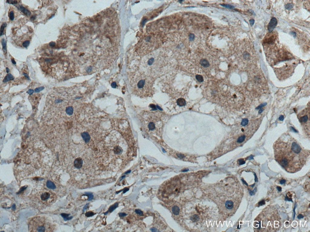 Immunohistochemistry (IHC) staining of human breast cancer tissue using MAEA Polyclonal antibody (28363-1-AP)