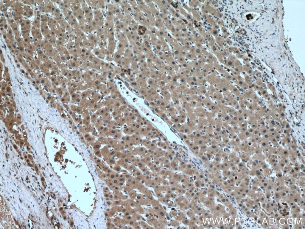 Immunohistochemistry (IHC) staining of human liver cancer tissue using MAEA Polyclonal antibody (28363-1-AP)