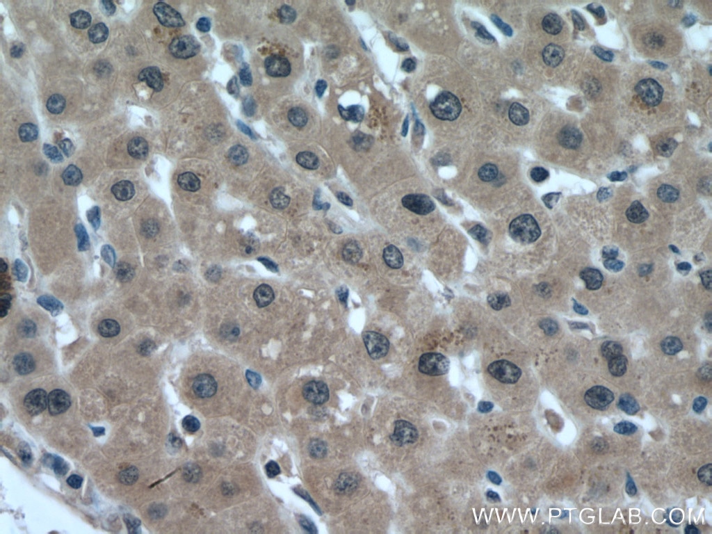 Immunohistochemistry (IHC) staining of human liver cancer tissue using MAEA Polyclonal antibody (28363-1-AP)