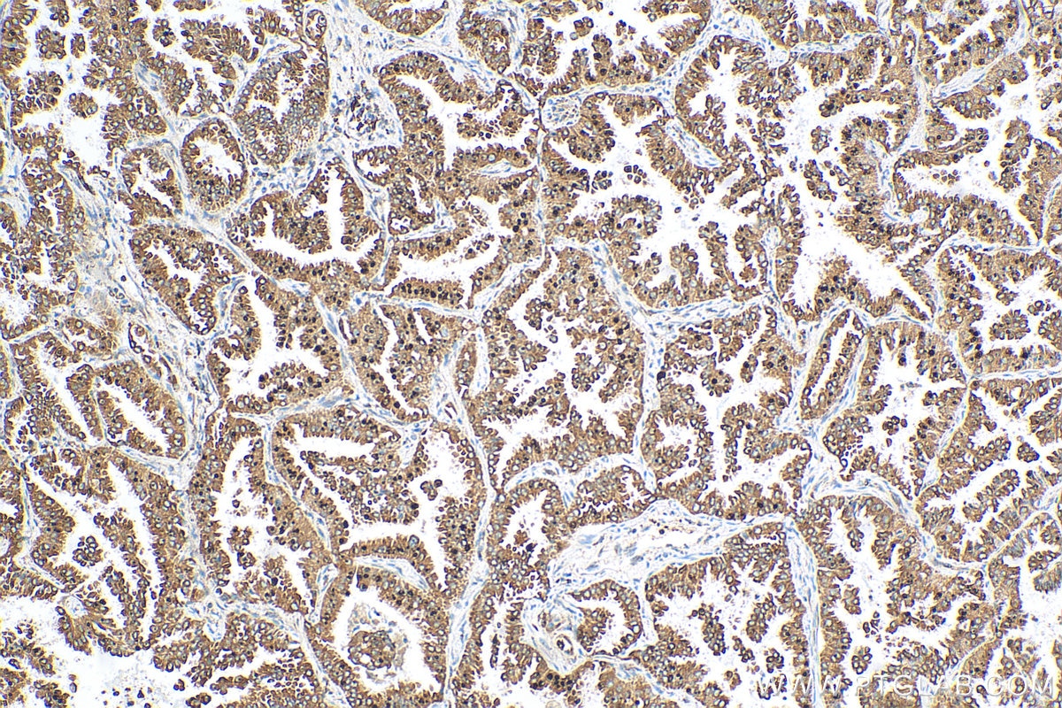 Immunohistochemistry (IHC) staining of human lung cancer tissue using MAFF Polyclonal antibody (12771-1-AP)