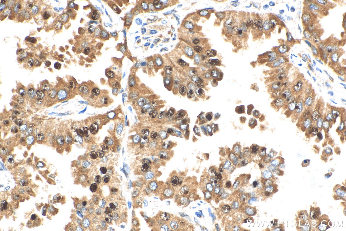 Immunohistochemistry (IHC) staining of human lung cancer tissue using MAFF Polyclonal antibody (12771-1-AP)