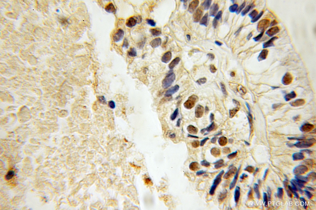 Immunohistochemistry (IHC) staining of human ovary tumor tissue using MAFF Polyclonal antibody (12771-1-AP)