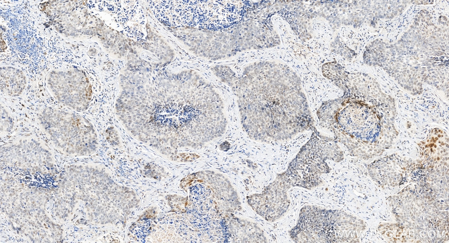 Immunohistochemical analysis of paraffin-embedded human lung cancer tissue slide using 85186-3-RR (MAFF antibody) at dilution of 1:200 (under 20x lens). Heat mediated antigen retrieval with Tris-EDTA buffer (pH 9.0). Immunohistochemistry (IHC) staining of human lung cancer tissue using MAFF Recombinant monoclonal antibody (85186-3-RR)
