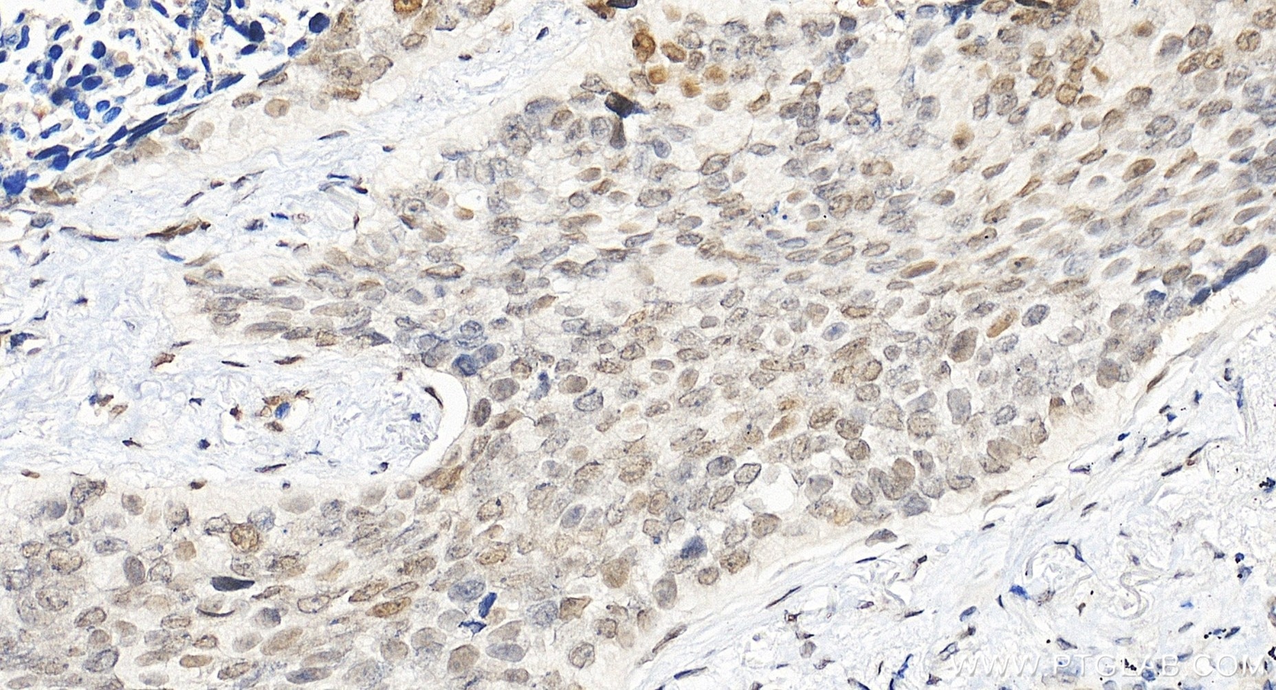 Immunohistochemical analysis of paraffin-embedded human lung cancer tissue slide using 85186-3-RR (MAFF antibody) at dilution of 1:200 (under 20x lens). Heat mediated antigen retrieval with Tris-EDTA buffer (pH 9.0). Immunohistochemistry (IHC) staining of human lung cancer tissue using MAFF Recombinant monoclonal antibody (85186-3-RR)