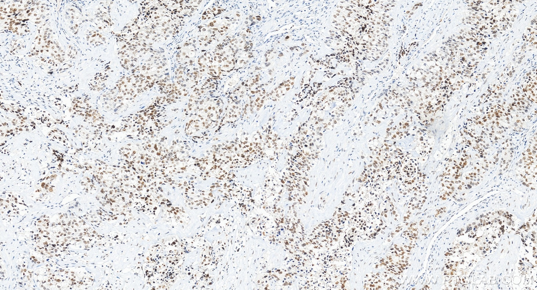 Immunohistochemical analysis of paraffin-embedded human ovary cancer tissue slide using 85186-3-RR (MAFF antibody) at dilution of 1:200 (under 20x lens). Heat mediated antigen retrieval with Tris-EDTA buffer (pH 9.0). Immunohistochemistry (IHC) staining of human ovary cancer tissue using MAFF Recombinant monoclonal antibody (85186-3-RR)
