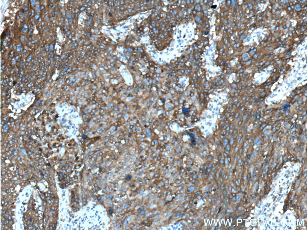 Immunohistochemistry (IHC) staining of human lung cancer tissue using MAGEA3 Monoclonal antibody (60054-1-Ig)
