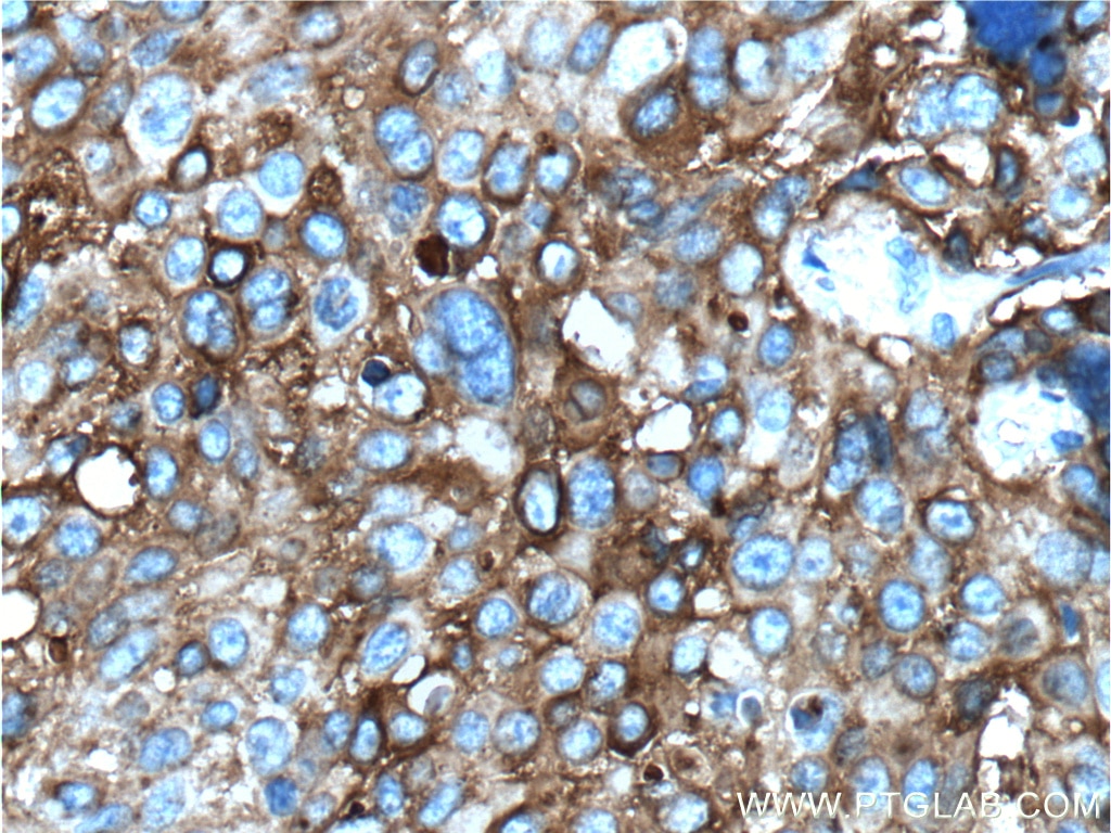 Immunohistochemistry (IHC) staining of human lung cancer tissue using MAGEA3 Monoclonal antibody (60054-1-Ig)