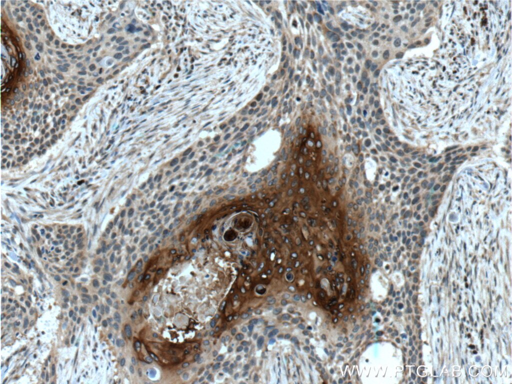Immunohistochemistry (IHC) staining of human oesophagus cancer tissue using MAGEA3 Monoclonal antibody (60054-1-Ig)