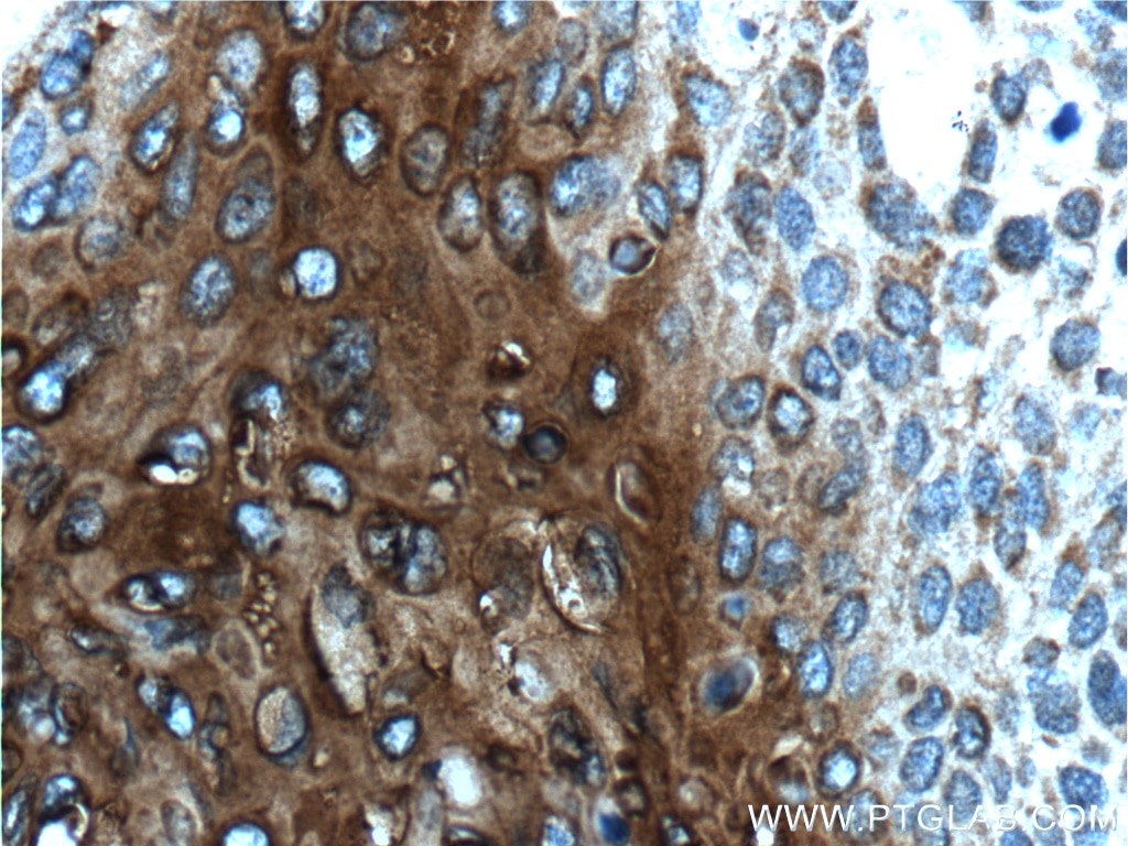 IHC staining of human oesophagus cancer using 60054-1-Ig