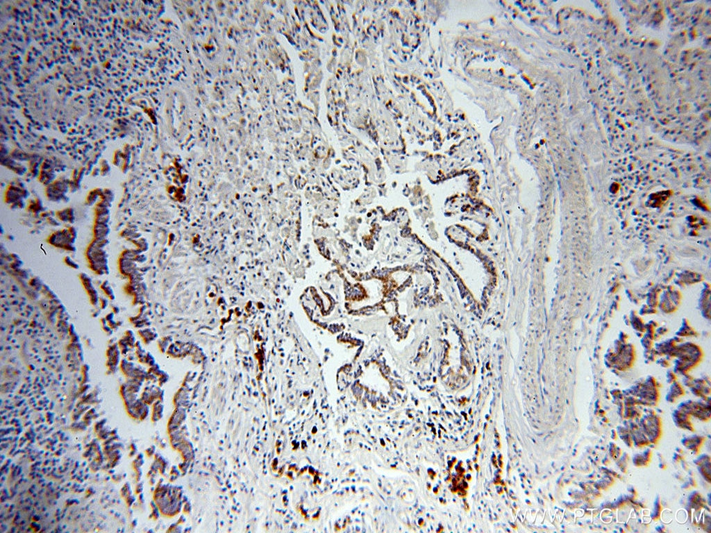 Immunohistochemistry (IHC) staining of human lung cancer tissue using MAGEA3 Monoclonal antibody (60054-1-Ig)