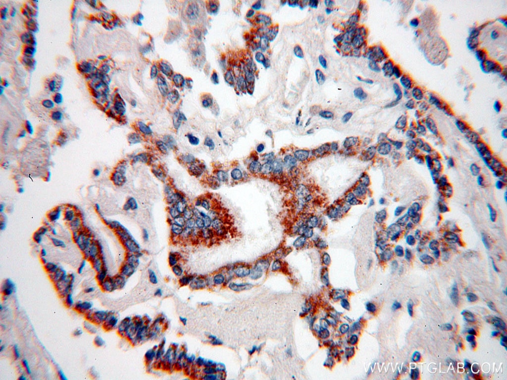 Immunohistochemistry (IHC) staining of human lung cancer tissue using MAGEA3 Monoclonal antibody (60054-1-Ig)