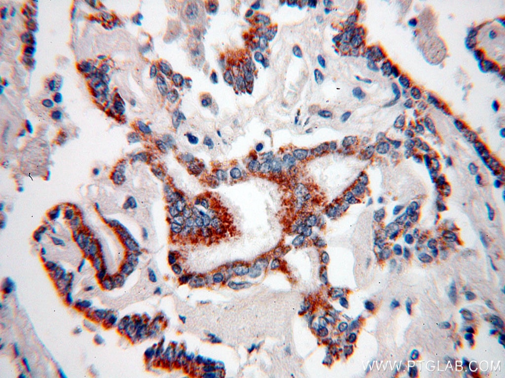 IHC staining of human lung cancer using 60054-1-Ig