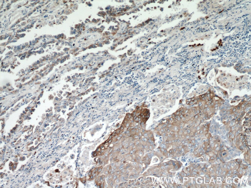 Immunohistochemistry (IHC) staining of human lung cancer tissue using MAGEA3 Monoclonal antibody (60054-1-Ig)