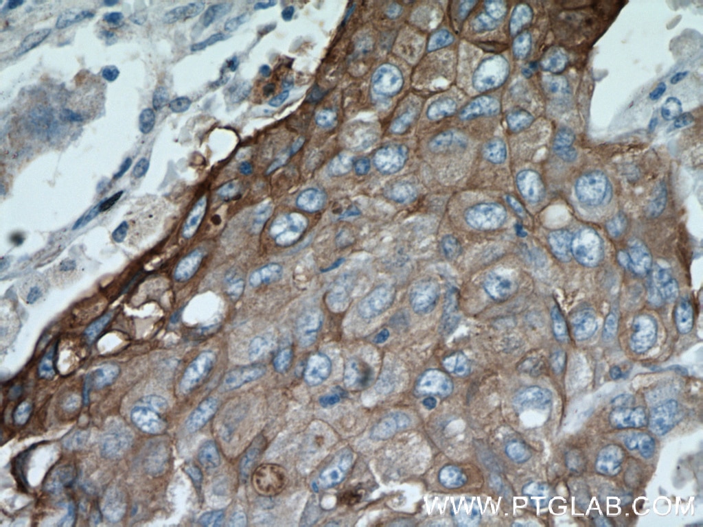 IHC staining of human lung cancer using 60054-1-Ig