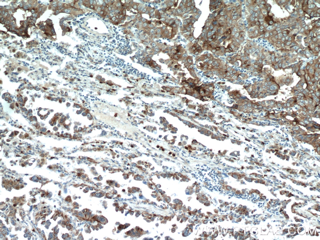 Immunohistochemistry (IHC) staining of human lung cancer tissue using MAGEA3 Monoclonal antibody (60054-1-Ig)