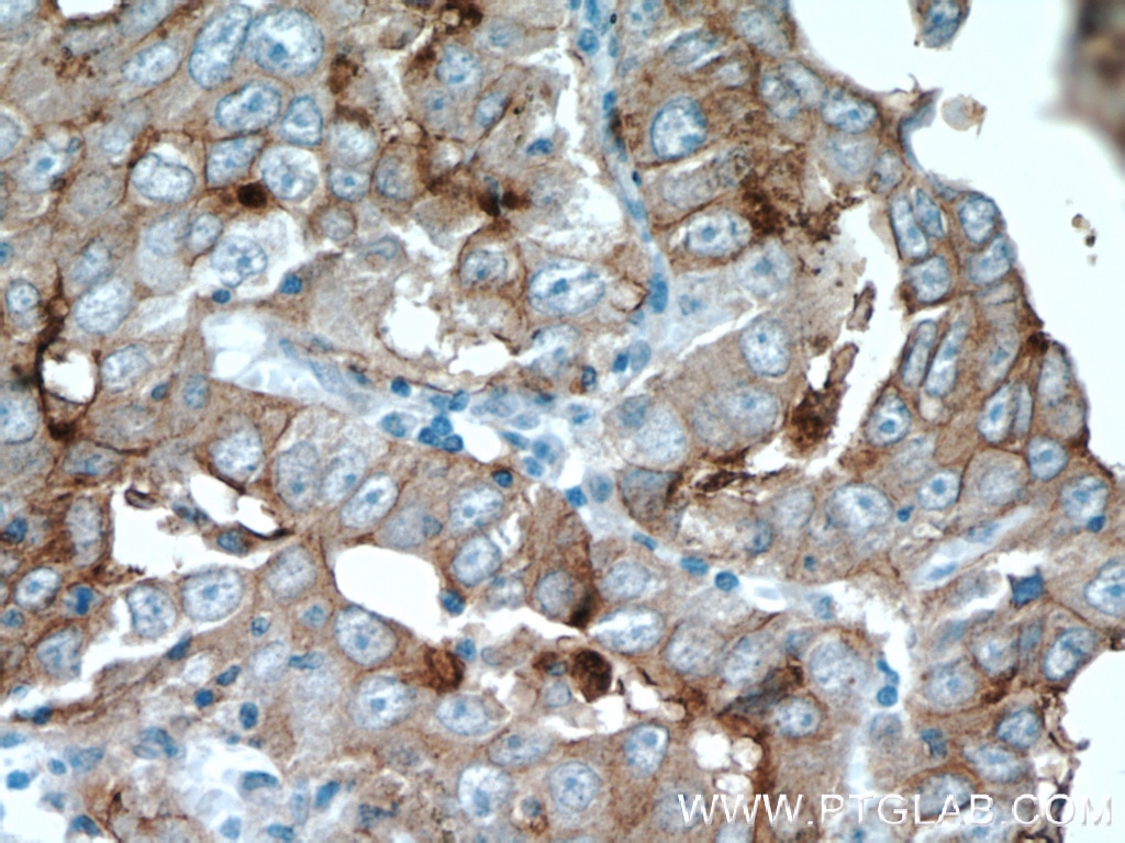 IHC staining of human lung cancer using 60054-1-Ig