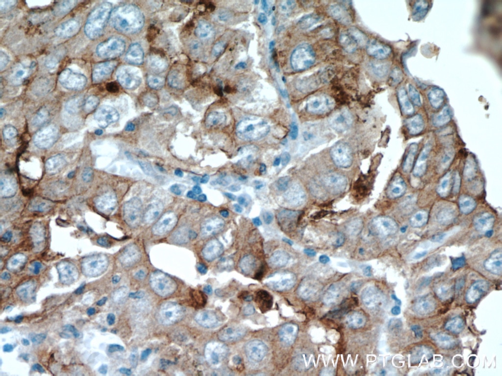 Immunohistochemistry (IHC) staining of human lung cancer tissue using MAGEA3 Monoclonal antibody (60054-1-Ig)