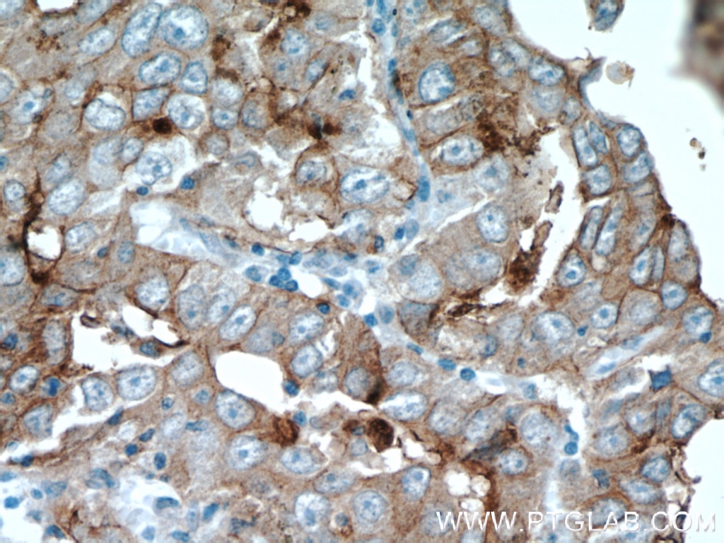 Immunohistochemistry (IHC) staining of human lung cancer tissue using MAGEA3 Monoclonal antibody (60054-1-Ig)