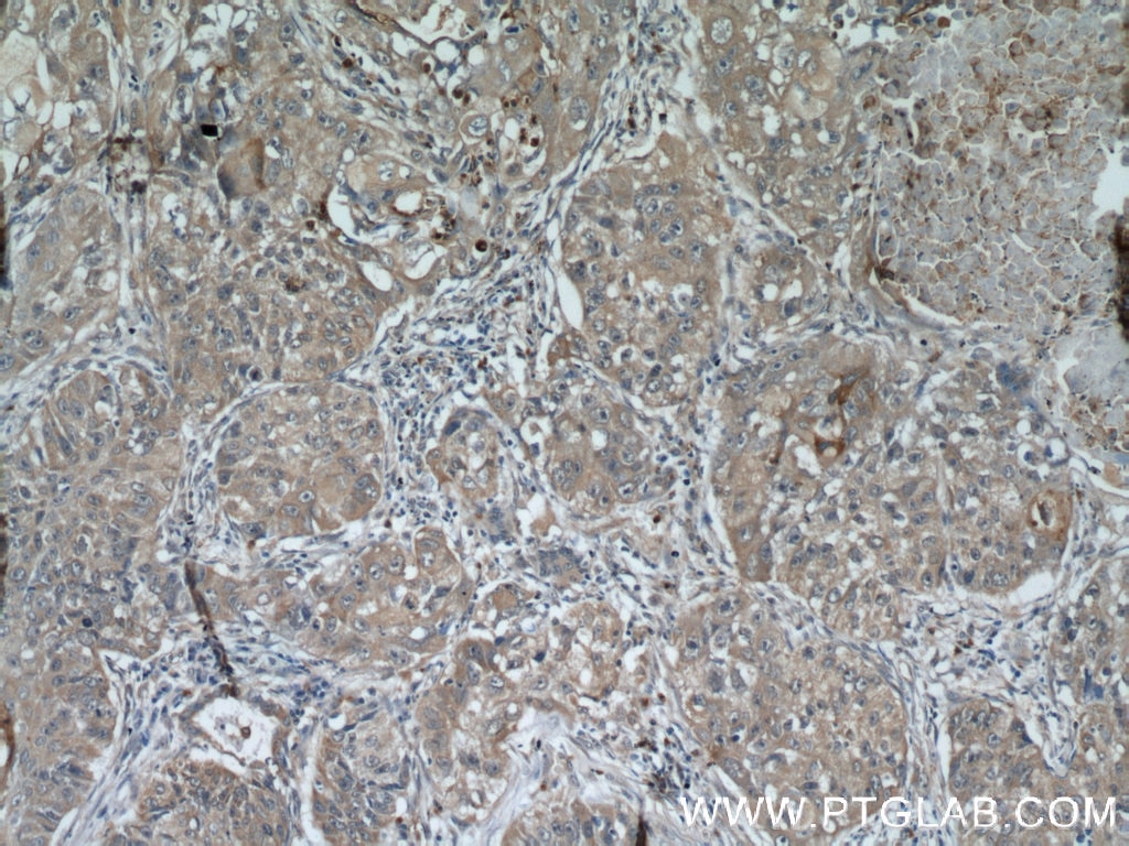 Immunohistochemistry (IHC) staining of human lung cancer tissue using MAGEA3 Monoclonal antibody (60054-1-Ig)