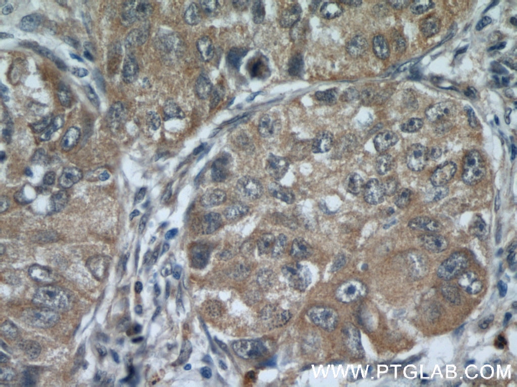 Immunohistochemistry (IHC) staining of human lung cancer tissue using MAGEA3 Monoclonal antibody (60054-1-Ig)