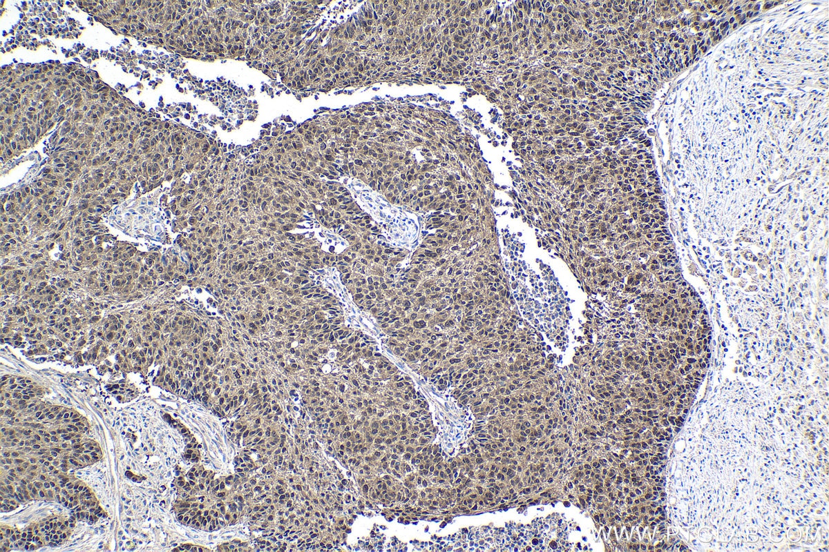 Immunohistochemistry (IHC) staining of human lung cancer tissue using MAGEA4 Polyclonal antibody (12508-1-AP)