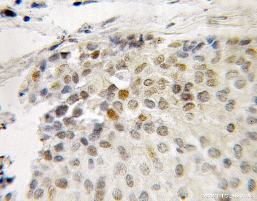 Immunohistochemistry (IHC) staining of human breast cancer tissue using MAGEA4 Polyclonal antibody (12508-1-AP)