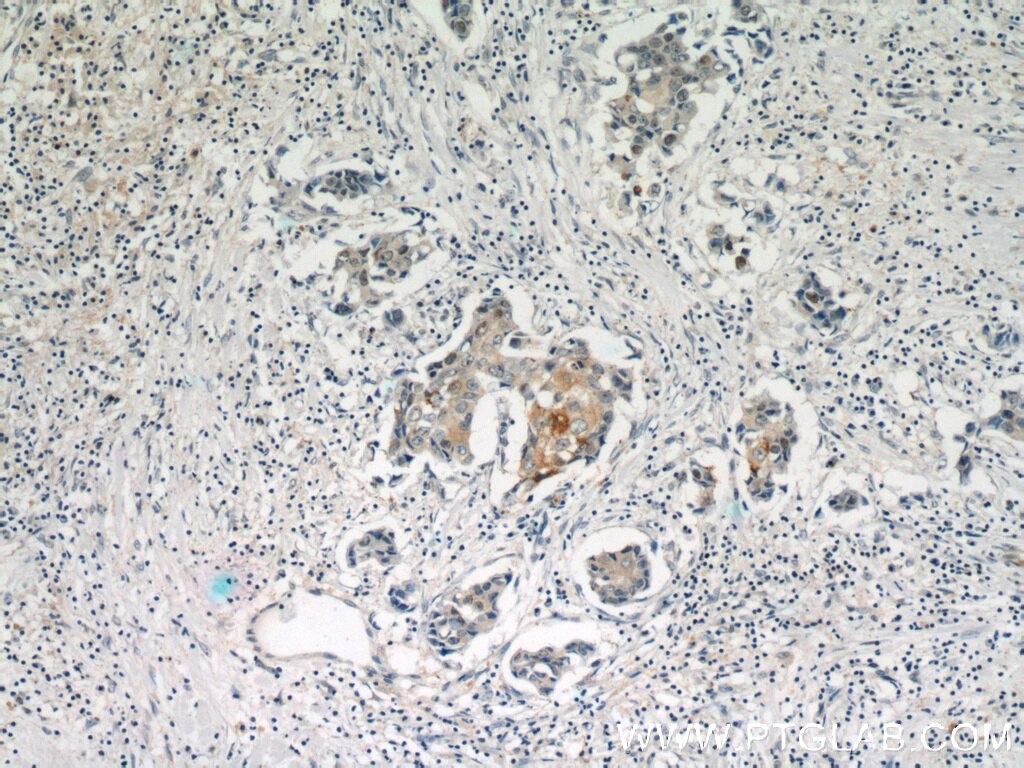 Immunohistochemistry (IHC) staining of human breast cancer tissue using MAGEA4 Polyclonal antibody (55109-1-AP)