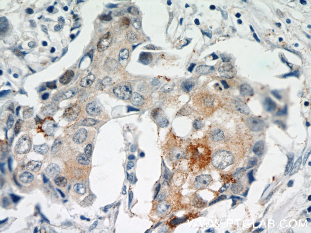 Immunohistochemistry (IHC) staining of human breast cancer tissue using MAGEA4 Polyclonal antibody (55109-1-AP)