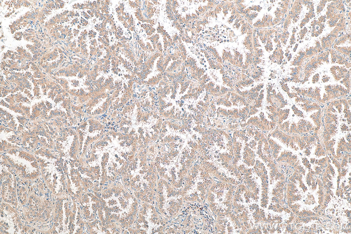 Immunohistochemistry (IHC) staining of human lung cancer tissue using MAGEA6 Polyclonal antibody (14602-1-AP)