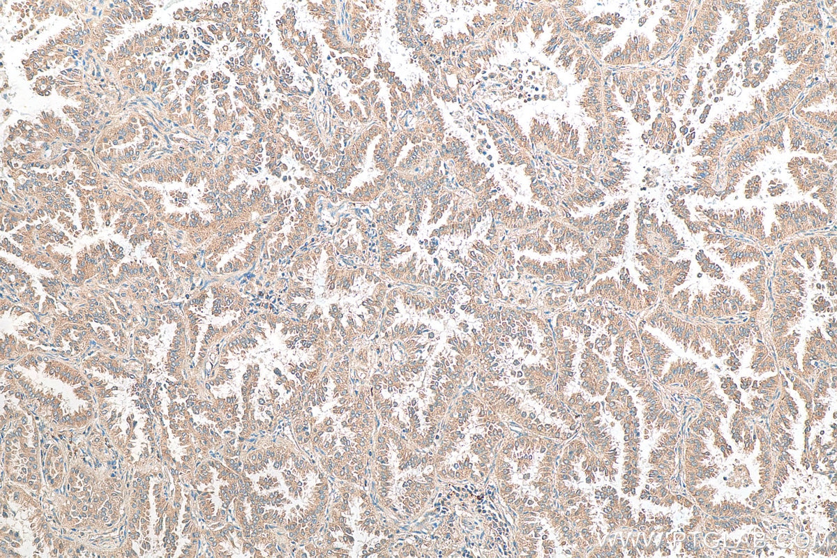 IHC staining of human lung cancer using 14602-1-AP