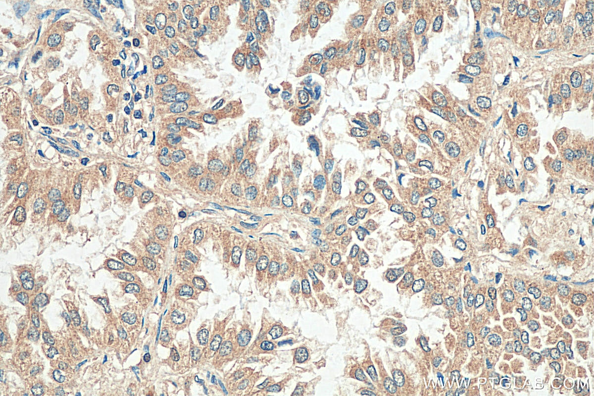 IHC staining of human lung cancer using 14602-1-AP