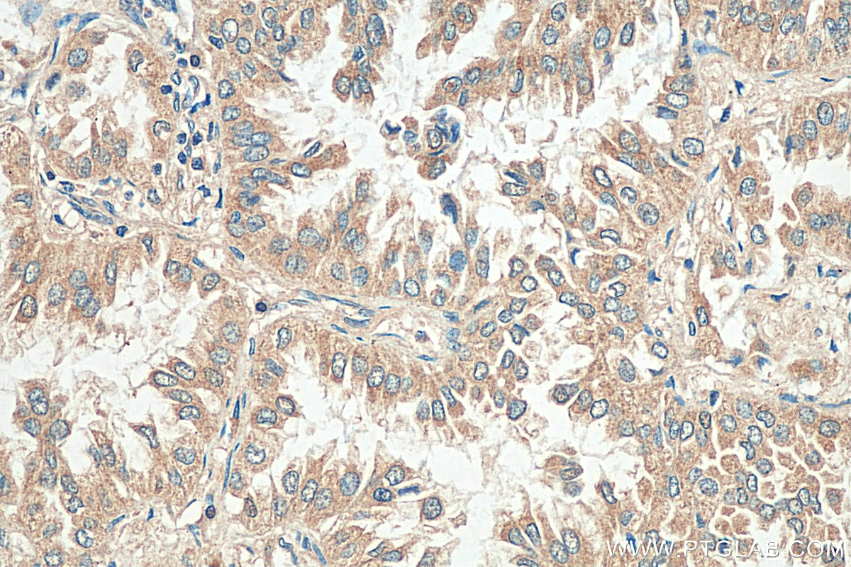 Immunohistochemistry (IHC) staining of human lung cancer tissue using MAGEA6 Polyclonal antibody (14602-1-AP)