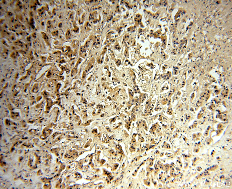 Immunohistochemistry (IHC) staining of human breast cancer tissue using MAGEA6 Polyclonal antibody (14602-1-AP)