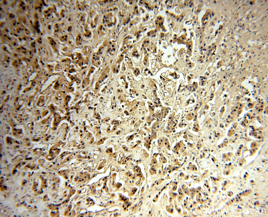 Immunohistochemistry (IHC) staining of human breast cancer tissue using MAGEA6 Polyclonal antibody (14602-1-AP)