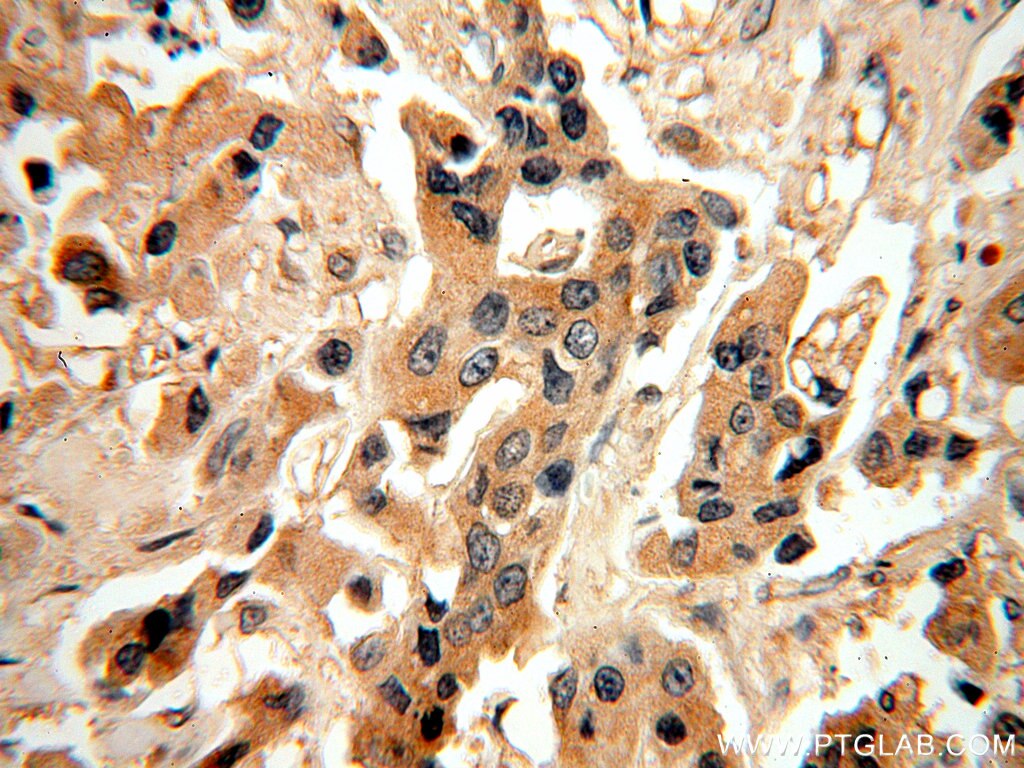 Immunohistochemistry (IHC) staining of human breast cancer tissue using MAGEA6 Polyclonal antibody (14602-1-AP)