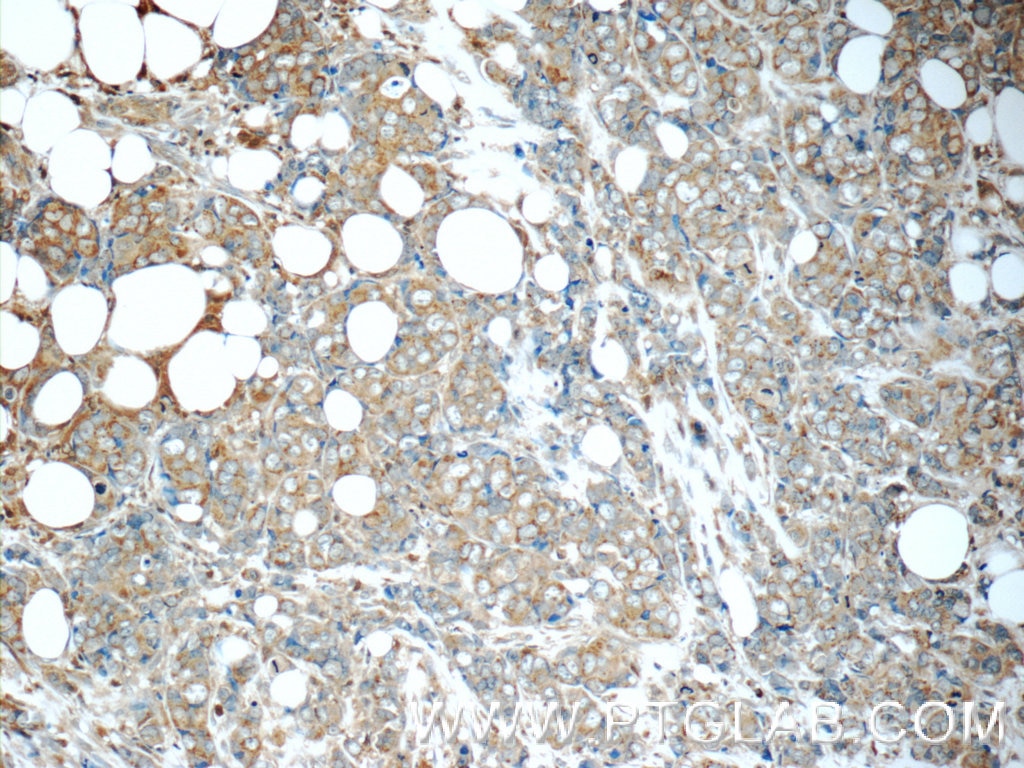 Immunohistochemistry (IHC) staining of human breast cancer tissue using MAGEC2 Polyclonal antibody (10280-1-AP)