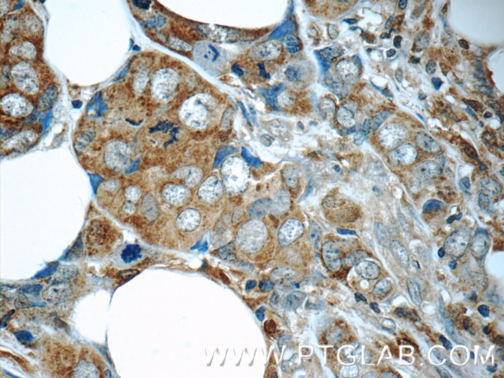 Immunohistochemistry (IHC) staining of human breast cancer tissue using MAGEC2 Polyclonal antibody (10280-1-AP)