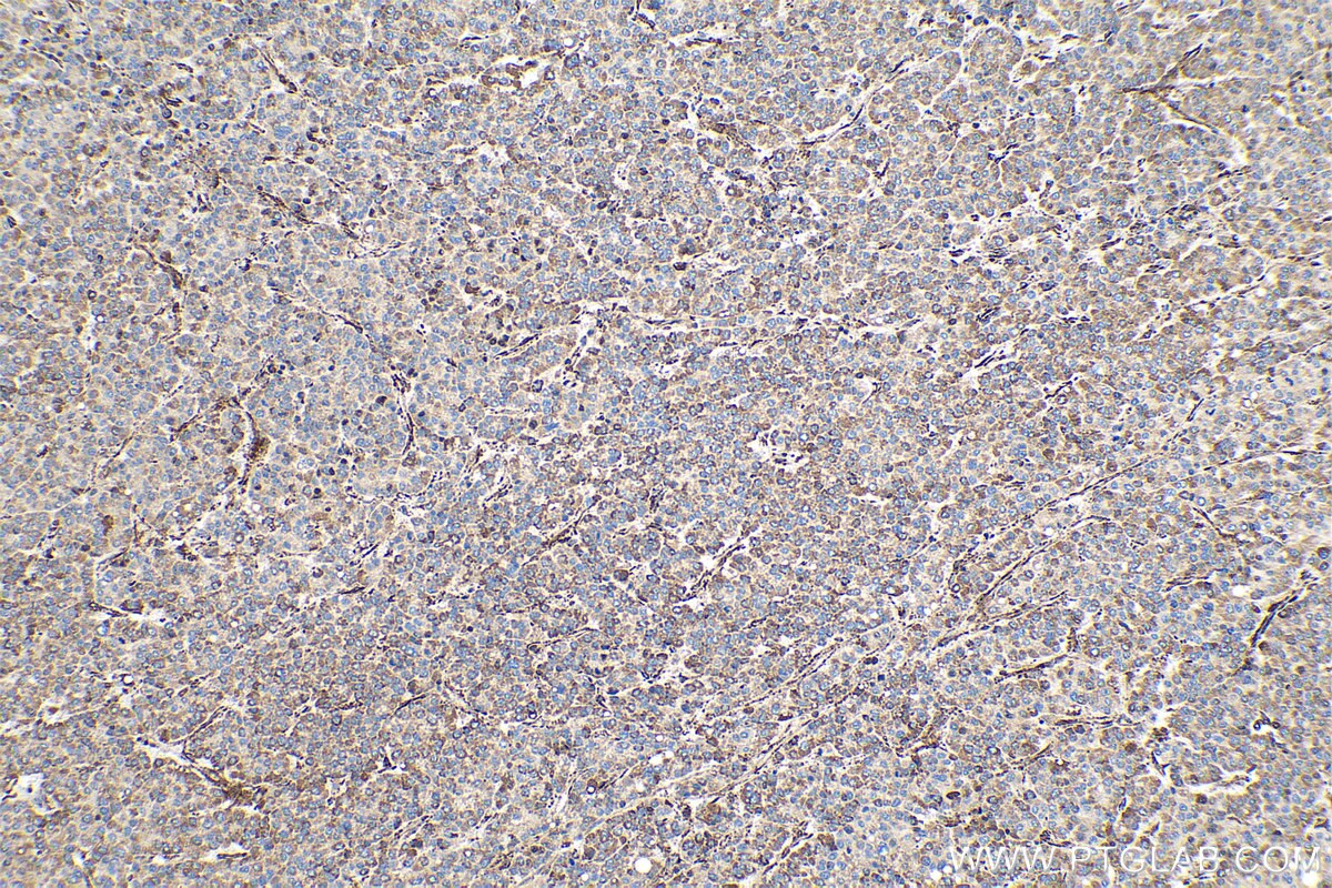 Immunohistochemistry (IHC) staining of human liver cancer tissue using MAGEC2 Polyclonal antibody (10280-1-AP)