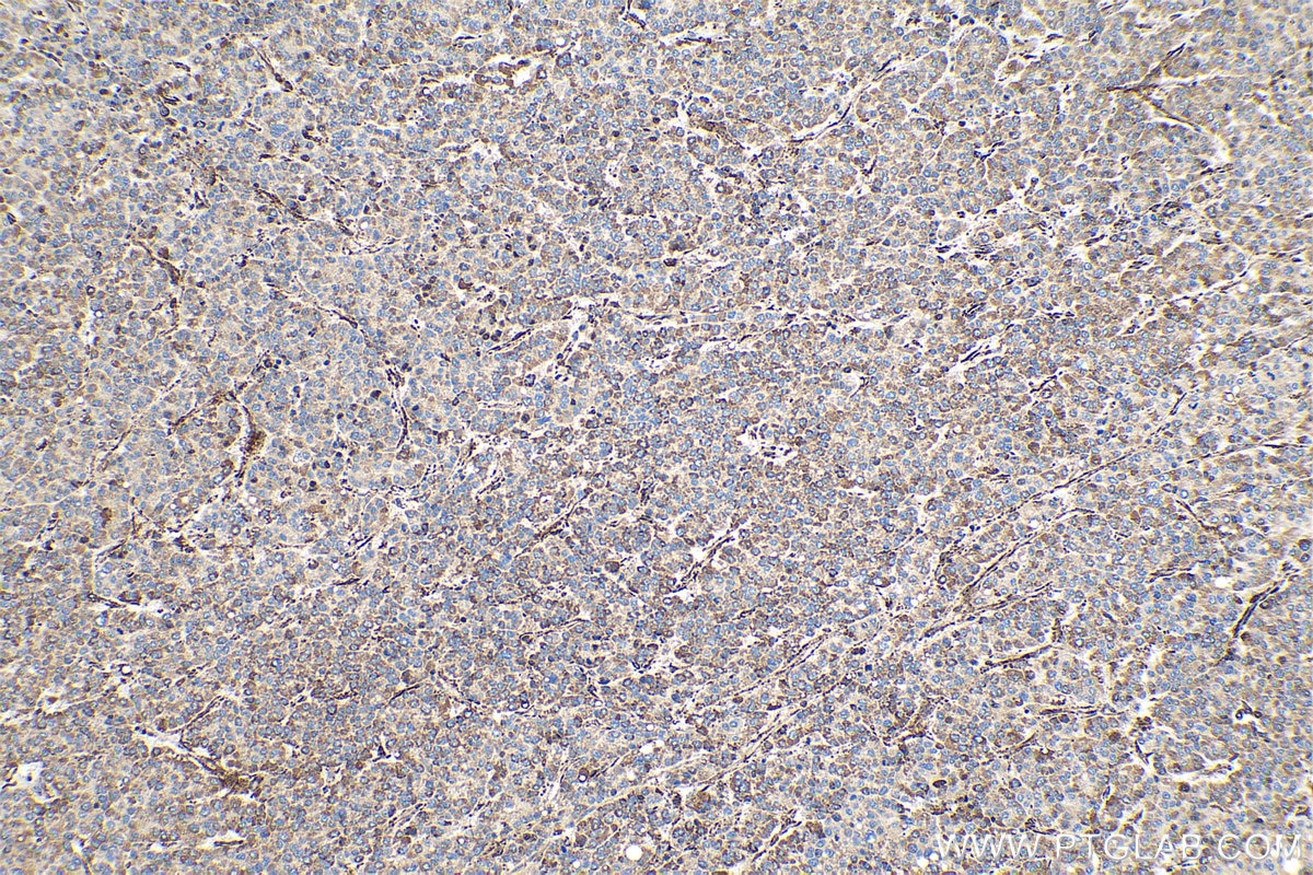 IHC staining of human liver cancer using 10280-1-AP