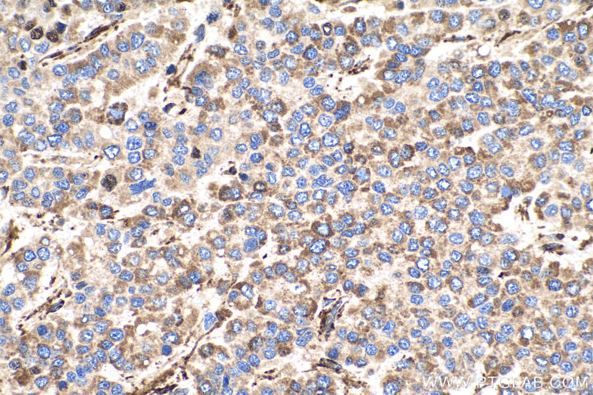 Immunohistochemistry (IHC) staining of human liver cancer tissue using MAGEC2 Polyclonal antibody (10280-1-AP)